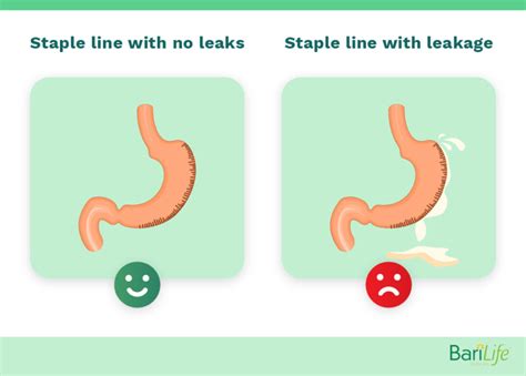 stomach leak symptoms|Risks of Gastric Bypass Surgery: Anastomotic Leaking